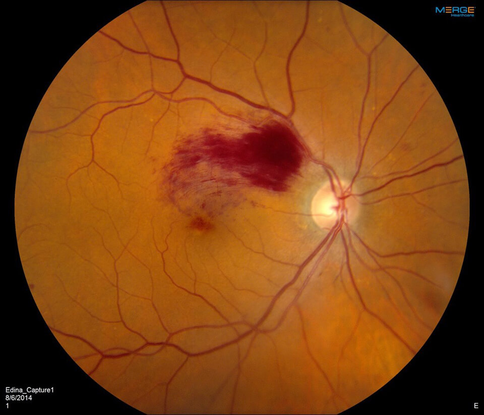 Branch Retinal Vein Occlusion Brvo Treatment In Minnesota Rcm