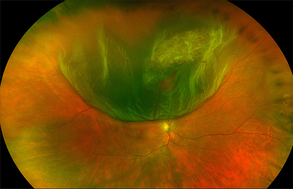 retina detachment symptoms